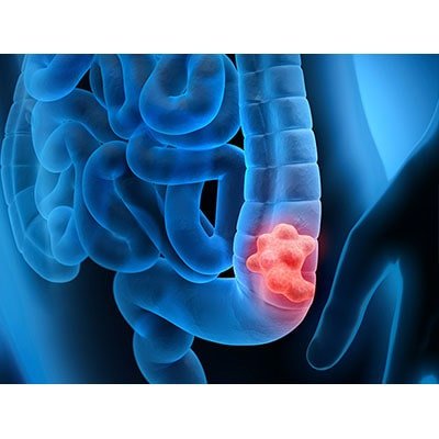 Best Cancer Doctor in gurgaon India